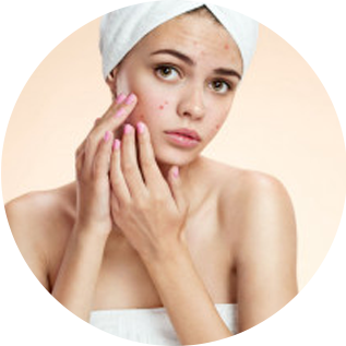 Treating Moderate to Severe Acne