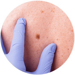 Skin Cancer Warning Signs — What To Look For