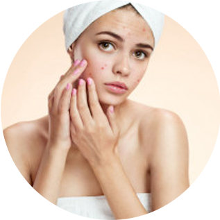 Treating Moderate to Severe Acne